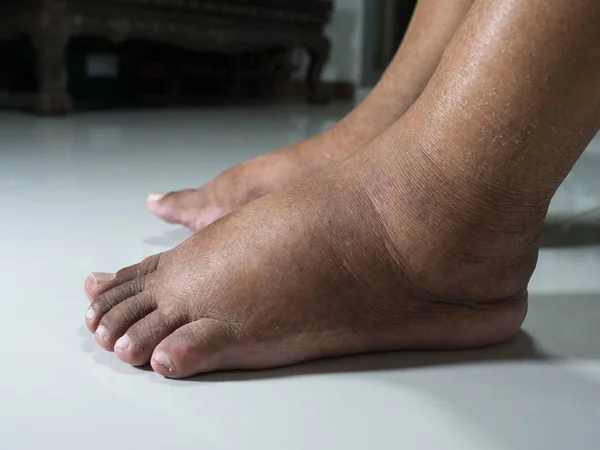 Why do my feet swell at the end of the day
